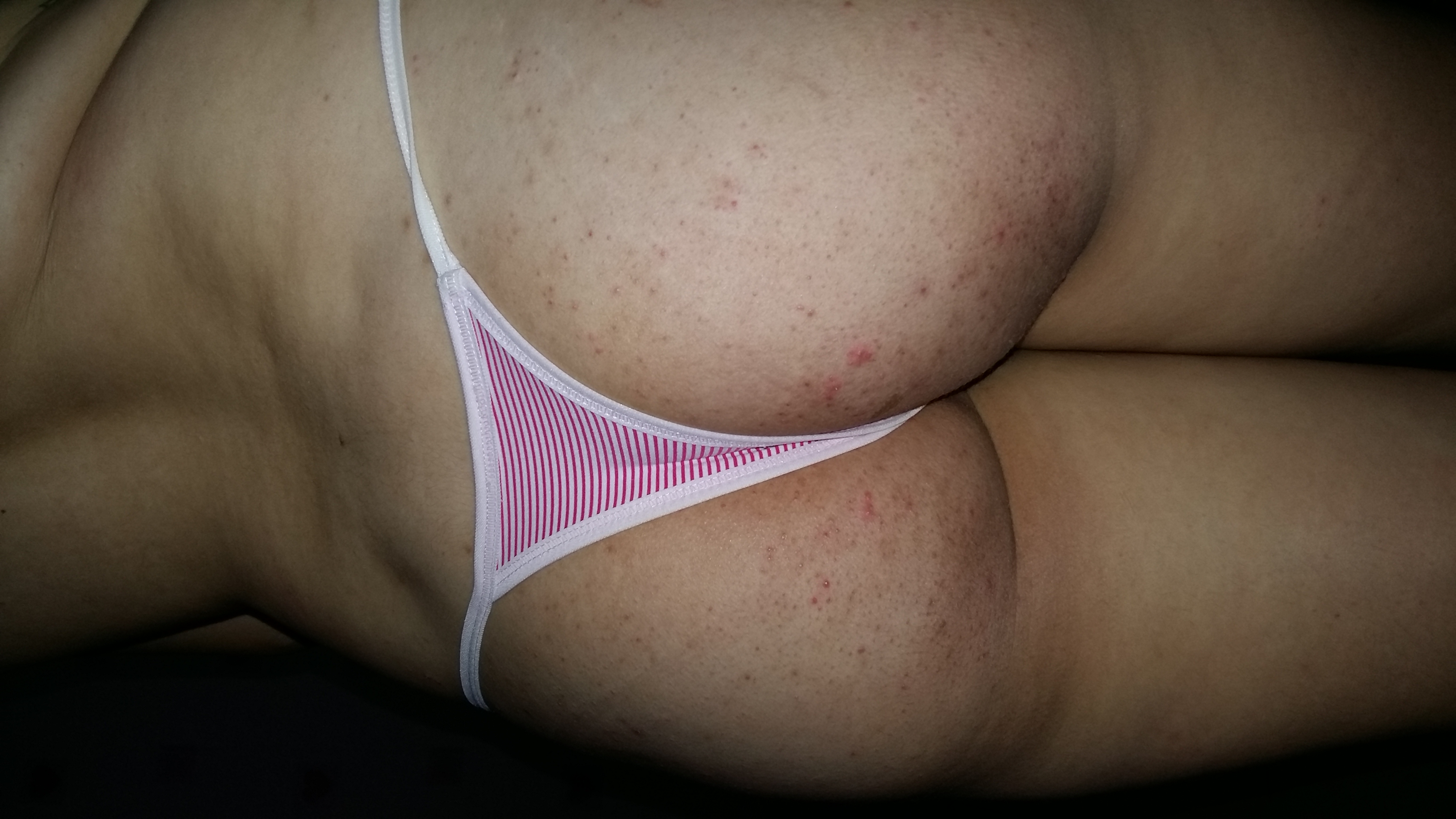 Foliculite nas nádegas antes do Tend Skin — bolinhas vermelhas e pelos encravados